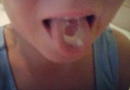 mouth burn from sour candy