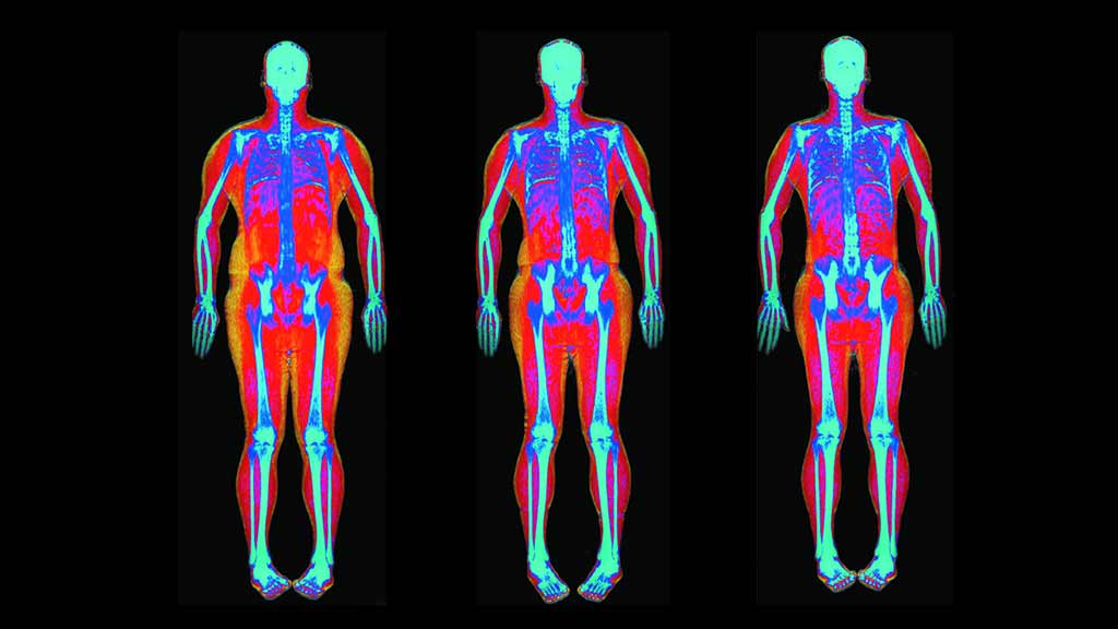 Do You Need A Dexa Scan Choice