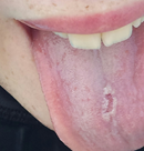 mouth burn from sour candy
