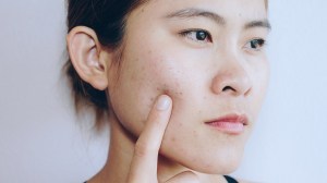 young woman with acne
