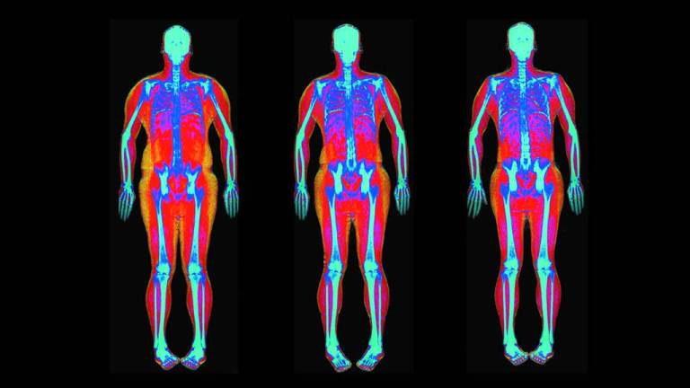 Sample of a DEXA scan