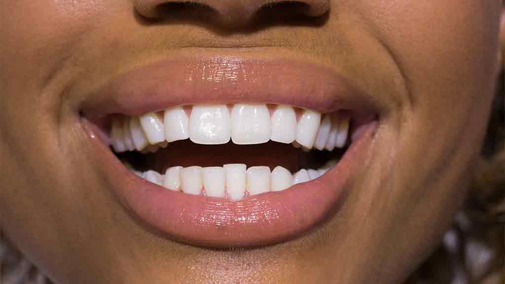 Teeth whitening treatments - dentists, dental care and ...